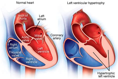 lv concentric hypertrophy